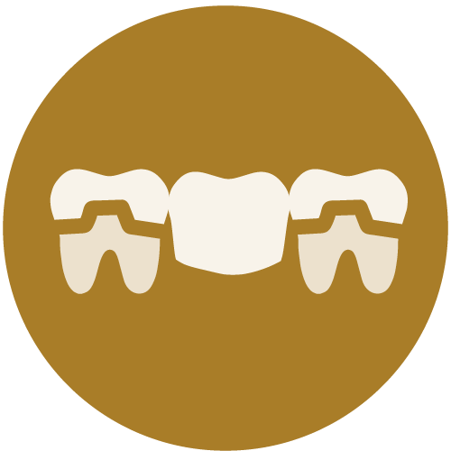 Dental Bridges